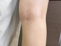 北同御贡静脉曲张冷敷凝胶蚯蚓腿专用膏药非贴下肢肿胀青筋凸起精索 1盒 实拍图