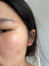 源药师 金花消痤颗粒 金花消痤疮颗粒痤疮粉刺去痘痘清热中药内调痤疮专用药 【5盒金花+1支阿达帕林】超值”战痘“组合 实拍图