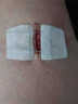 施美乐医用减张器张力贴皮肤减张贴儿童面部疤痕伤口甲状腺剖腹产术后 减张器 长39mm 2扣*2贴【医院外科同款】 实拍图