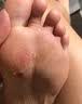 [福元]硝酸咪康唑乳膏 脚气药止痒脱皮烂脚丫真菌感染药治脚脱皮抗真菌干裂脱皮脚后跟干裂膏角化型脚气 2%*20g 2盒装 【医用杀菌除脚气药膏】 实拍图