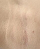 秀碧疤痕膏【德国原装】伤疤刀疤剖腹产 儿童凹陷增生去疤膏 身体护理 大支30g*1支 德国原装-非港版 实拍图