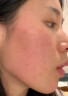 医用冷敷贴面膜械字号医美术后消炎美白补水晒后修复收缩毛孔祛痘淡化痘印生长因子重组三型人源胶原蛋白敷料 实拍图