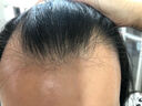 【男士进阶套装】蔓迪生发喷雾90ml*2瓶+精灵瓶10ml*2瓶 5%米诺地尔酊（浓密头顶发际线 随行轻松生发） 实拍图