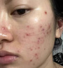 医用冷敷贴面膜械字号医美术后消炎美白补水晒后修复收缩毛孔祛痘淡化痘印生长因子重组三型人源胶原蛋白敷料 实拍图