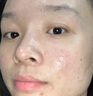 Newliann医用黑面膜械字号祛痘祛痘印术后消炎修复医美美白补水修护男士女 实拍图