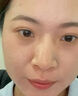 Newliann医用黑面膜械字号祛痘祛痘印术后消炎修复医美美白补水修护男士女 实拍图
