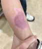秀碧疤痕膏【德国原装】伤疤刀疤剖腹产 儿童凹陷增生去疤膏 身体护理 大支30g*1支 德国原装-非港版 实拍图