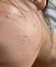医用冷敷贴面膜型械字号透明质酸钠修复贴敷料医美术后消炎去红美白补水晒后修复收缩毛孔祛痘控油淡化痘印 实拍图