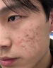 同仁堂（TRT）祛痘膏去痘痘和痘印痘坑初高中生男女学生粉刺青春痘20g 实拍图