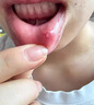 纽医生口腔溃疡贴片膜专用口腔溃疡凝胶喷剂成人儿童溃疡贴可搭配西瓜霜 实拍图