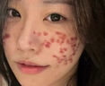 Newliann医用重组胶原蛋白修复敷料乳液人表皮生长因子凝胶皮肤屏障面霜 实拍图