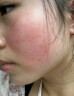 医用冷敷贴面膜械字号医美术后消炎美白补水晒后修复收缩毛孔祛痘淡化痘印生长因子重组三型人源胶原蛋白敷料 实拍图
