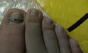 脚医生足部固定器甲沟炎矫正器嵌甲专用正甲贴片脚趾甲长肉里 实拍图