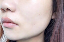 医用精华液械字号收缩毛孔粗大修复细致去黑头粉刺闭口男士女士祛痘印黑色素沉淀控油淡化痘印痘坑透明质酸钠 实拍图