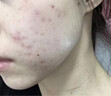 BEAUTY NOTES壬二酸20%祛痘膏痤疮专用凝胶青少年学生青春痘淡修复 实拍图