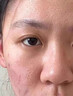 医用冷敷贴面膜型械字号透明质酸钠修复贴敷料医美术后消炎去红美白补水晒后修复收缩毛孔祛痘控油淡化痘印 实拍图