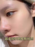 医用精华液械字号收缩毛孔粗大修复细致去黑头粉刺闭口男士女士祛痘印黑色素沉淀控油淡化痘印痘坑透明质酸钠 实拍图
