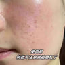 医用冷敷贴面膜型械字号透明质酸钠修复贴敷料医美术后消炎去红美白补水晒后修复收缩毛孔祛痘控油淡化痘印 实拍图