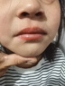 希格玛308白癜风治疗仪西格玛UVB银屑病紫外线准分子激光光疗仪医院同款 12强度308nm全身小面积可用 实拍图