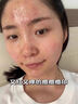 Newliann医用黑面膜械字号祛痘祛痘印术后消炎修复医美美白补水修护男士女 实拍图
