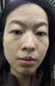 MN泪沟填充面部胶原蛋白丰盈额头法太阳穴令纹脸颊眼窝凹除陷去神器 1盒【医美原料】初步提亮眼周 实拍图