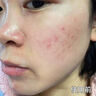 透真控油祛痘水乳套装茶树油修复痘印收缩毛孔补水爽肤水青少年护肤品 实拍图