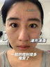 医用冷敷贴面膜械字号医美术后消炎美白补水晒后修复收缩毛孔祛痘淡化痘印生长因子重组三型人源胶原蛋白敷料 实拍图