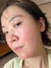 医用冷敷贴面膜械字号医美术后消炎美白补水晒后修复收缩毛孔祛痘淡化痘印生长因子重组三型人源胶原蛋白敷料 实拍图
