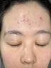 久卜制药祛痘膏痘坑印去黑头淡化黑色素沉淀痤疮修复疤痕青少年青春痘 1盒 实拍图