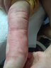 倍舒痕原装进口Dermatix医用硅凝胶祛疤膏 温和祛疤修复儿童适用15g 实拍图