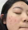 Newliann医用黑面膜械字号祛痘祛痘印术后消炎修复医美美白补水修护男士女 实拍图