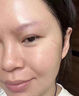 医用精华液械字号收缩毛孔粗大修复细致去黑头粉刺闭口男士女士祛痘印黑色素沉淀控油淡化痘印痘坑透明质酸钠 实拍图