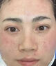 医用冷敷贴面膜型械字号透明质酸钠修复贴敷料医美术后消炎去红美白补水晒后修复收缩毛孔祛痘控油淡化痘印 实拍图