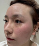 医用冷敷贴面膜械字号医美术后消炎美白补水晒后修复收缩毛孔祛痘淡化痘印生长因子重组三型人源胶原蛋白敷料 实拍图