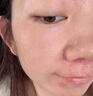 示博士酒糟鼻草莓鼻红肿玫瑰痤疮红鼻子专用去粉刺黑头红血丝螨虫修护软 三盒周期装（中度型） 搭红鼻子酒糟鼻头红肿消炎产品用 实拍图