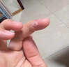 DR.SCT鸡眼贴鸡眼膏去除祛根去肉刺刺猴无痛脱落鸡眼连根拔跖疣专用非药 实拍图