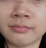 医用精华液械字号收缩毛孔粗大修复细致去黑头粉刺闭口男士女士祛痘印黑色素沉淀控油淡化痘印痘坑透明质酸钠 实拍图
