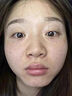 医用精华液械字号收缩毛孔粗大修复细致去黑头粉刺闭口男士女士祛痘印黑色素沉淀控油淡化痘印痘坑透明质酸钠 实拍图