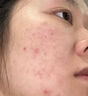 Newliann医用黑面膜械字号祛痘祛痘印术后消炎修复医美美白补水修护男士女 实拍图