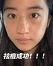 医用冷敷贴面膜械字号医美术后消炎美白补水晒后修复收缩毛孔祛痘淡化痘印生长因子重组三型人源胶原蛋白敷料 实拍图