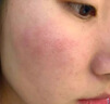 医用精华液械字号收缩毛孔粗大修复细致去黑头粉刺闭口男士女士祛痘印黑色素沉淀控油淡化痘印痘坑透明质酸钠 实拍图