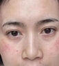医用冷敷贴面膜型械字号透明质酸钠修复贴敷料医美术后消炎去红美白补水晒后修复收缩毛孔祛痘控油淡化痘印 实拍图