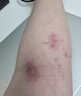 AFTER BITE美国进口户外舒缓啫喱蚊子隐翅虫蚊虫叮咬舒缓膏非止痒消肿神器 户外舒痒啫喱 20g 实拍图