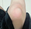 同仁堂滑膜炎贴膝盖部位型半月板损伤膝关节积水积液腿疼痛专用膏药贴 实拍图