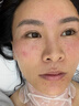 医用冷敷贴面膜械字号医美术后消炎美白补水晒后修复收缩毛孔祛痘淡化痘印生长因子重组三型人源胶原蛋白敷料 实拍图