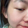 示博士酒糟鼻草莓鼻红肿玫瑰痤疮红鼻子专用去粉刺黑头红血丝螨虫修护软 三盒周期装（中度型） 搭红鼻子酒糟鼻头红肿消炎产品用 实拍图