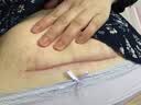 诗丽莎硅酮疤痕凝胶祛疤膏修护儿童成人创伤烧烫剖腹产增生凸起手术 9支【买5送同款4支】重度疤痕 实拍图