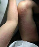 久冈制药荨麻疹专用膏皮肤瘙痒过敏止痒增强免疫力1盒装 实拍图