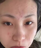 医用冷敷贴面膜型械字号透明质酸钠修复贴敷料医美术后消炎去红美白补水晒后修复收缩毛孔祛痘控油淡化痘印 实拍图