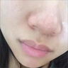 示博士酒糟鼻草莓鼻红肿玫瑰痤疮红鼻子专用去粉刺黑头红血丝螨虫修护软 三盒周期装（中度型） 搭红鼻子酒糟鼻头红肿消炎产品用 实拍图